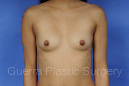 prev Case #1001011 Before