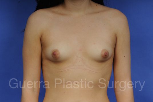 next Case #1001013 Before