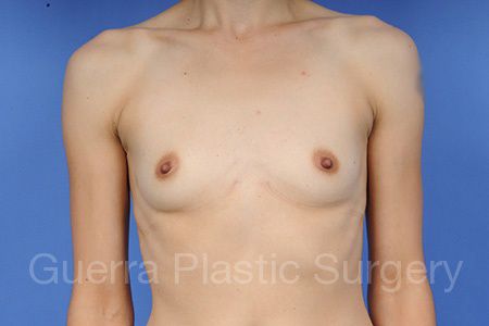 next Case #1001038 Before