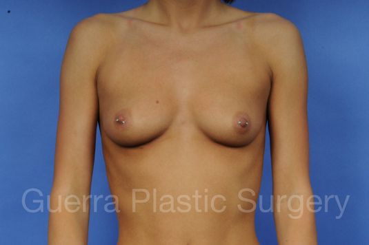 next Case #1001041 Before