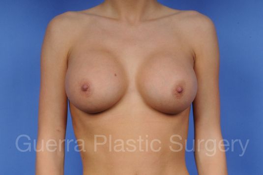 next Case #1001041 After