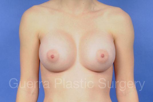 prev Case #1001047 After