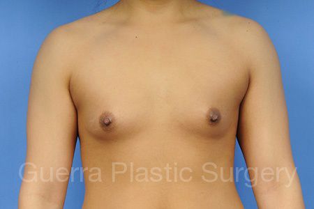 next Case #1001059 Before