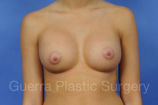 prev Case #1001062 After