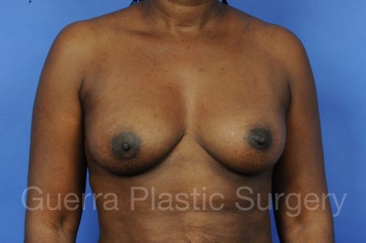 next Case #1001071 Before