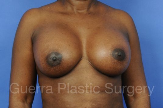 next Case #1001071 After