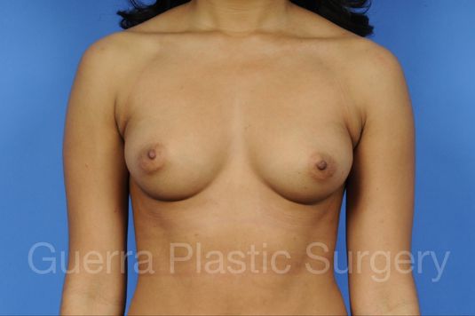 next Case #1001079 Before