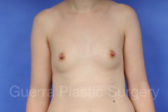 next Case #1001089 Before