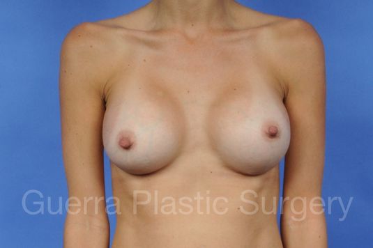 prev Case #1001091 After