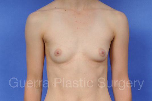 next Case #1003007 Before