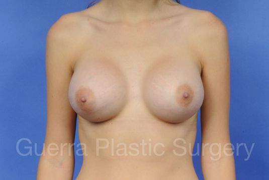 prev Case #1003010 After