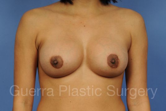 next Case #1002002 After