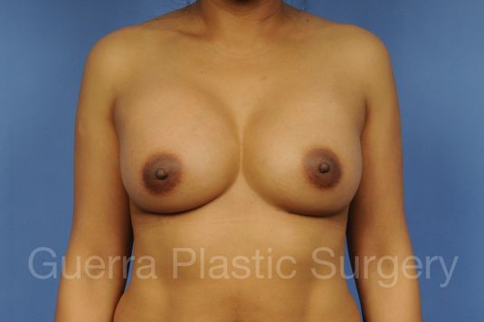 prev Case #1002003 After