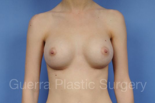 prev Case #1002007 After