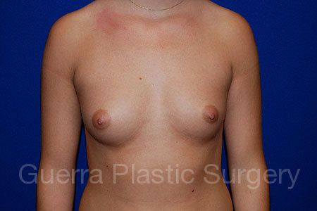 Breast Augmentation Case #19076 - before