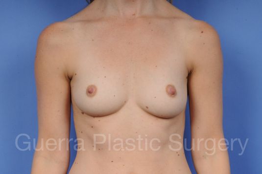 next Case #1002018 Before