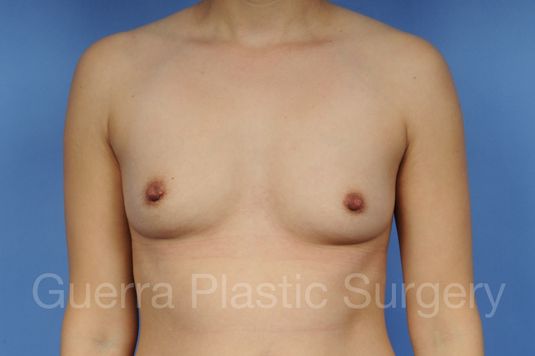 next Case #1002011 Before