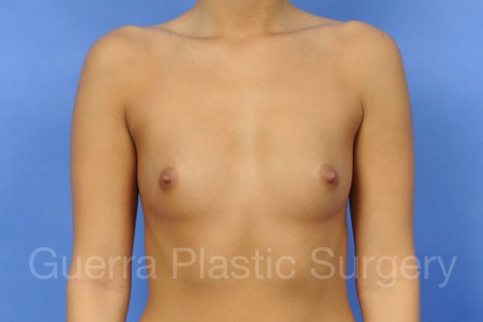 next Case #1002023 Before