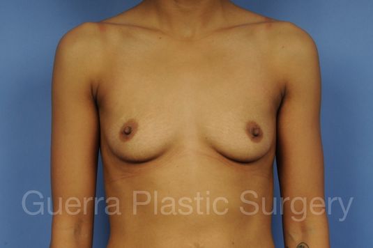 next Case #1002029 Before