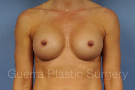 prev Case #1002012 After