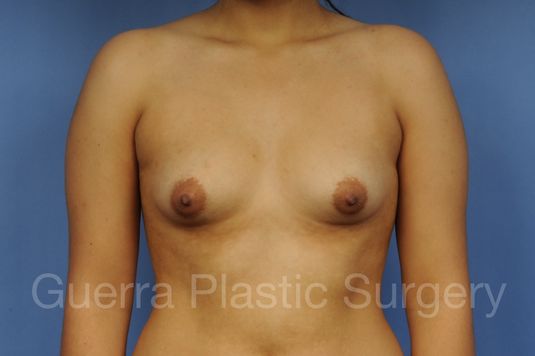 next Case #1002025 Before