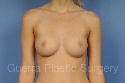 next Case #1003015 Before