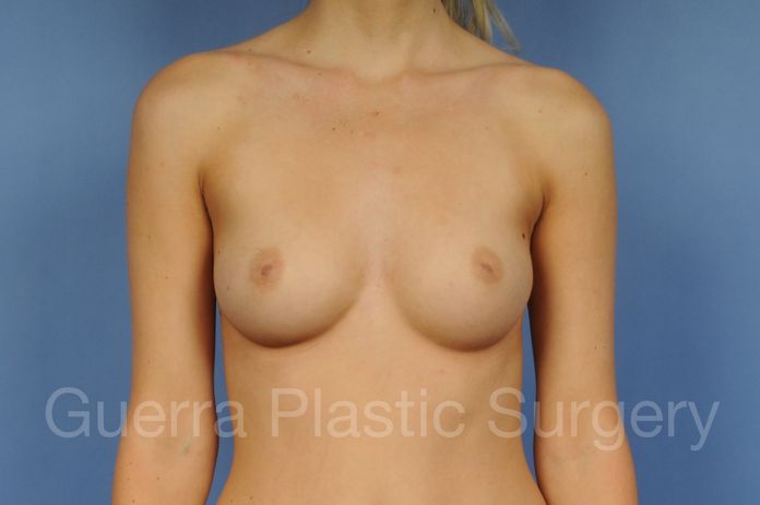 Breast Augmentation Case #1003015 - before