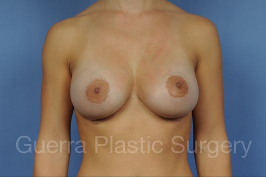 prev Case #1002047 After