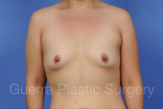 prev Case #1003016 Before