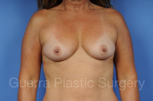 next Case #1004004 Before