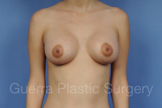 next Case #1003017 After