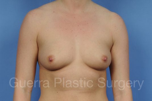 next Case #1001093 Before