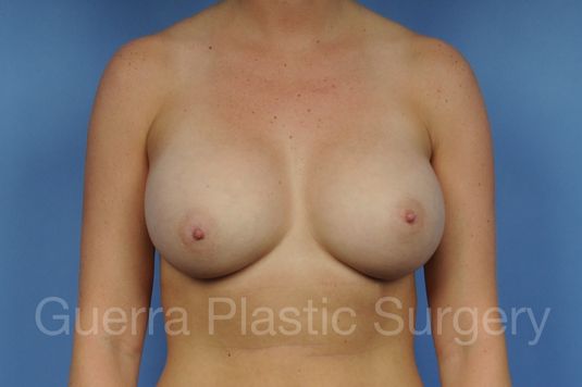 next Case #1001093 After