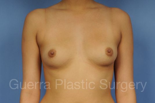 next Case #1001095 Before