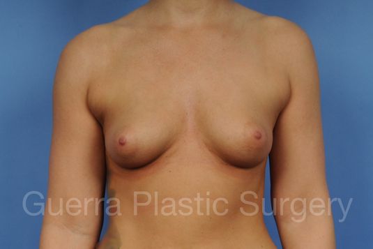 next Case #1001096 Before