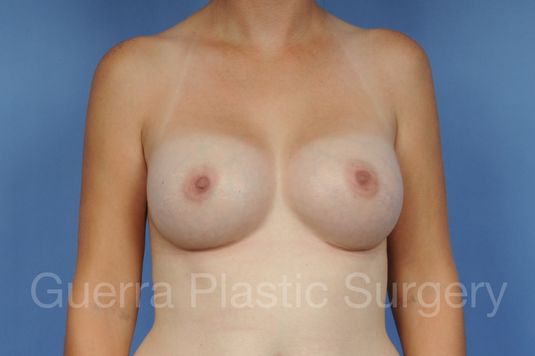 prev Case #1001100 After