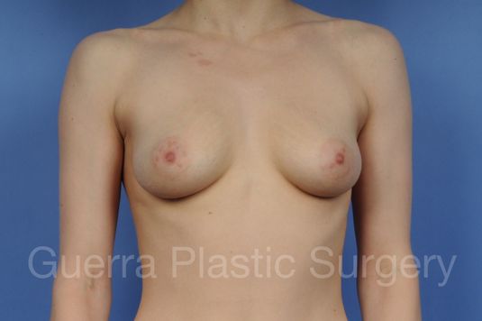 next Case #1001102 Before