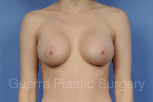 next Case #1001102 After