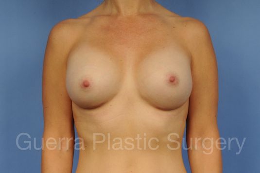 next Case #1001103 After