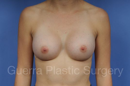 next Case #1001106 After