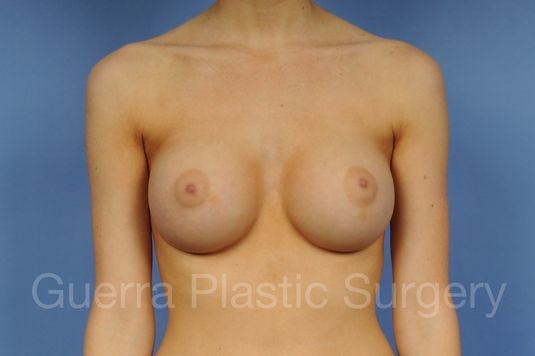 next Case #1001107 After