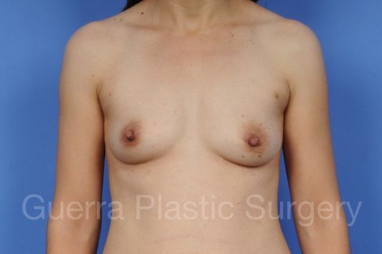 next Case #1001109 Before