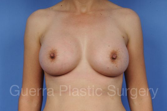 next Case #1001109 After