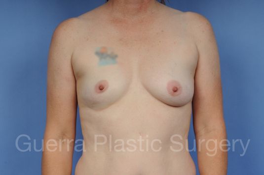 prev Case #1001110 Before