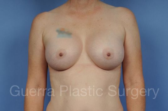 prev Case #1001110 After