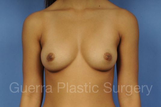 next Case #1001111 Before