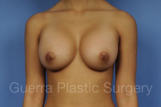 next Case #1001111 After