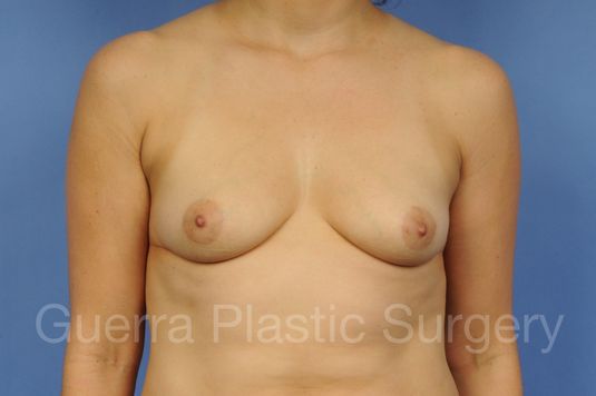 next Case #1001115 Before