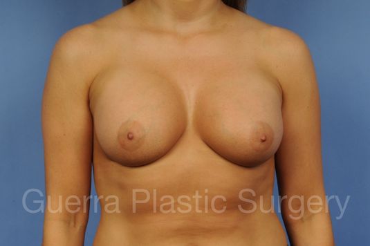 next Case #1001115 After