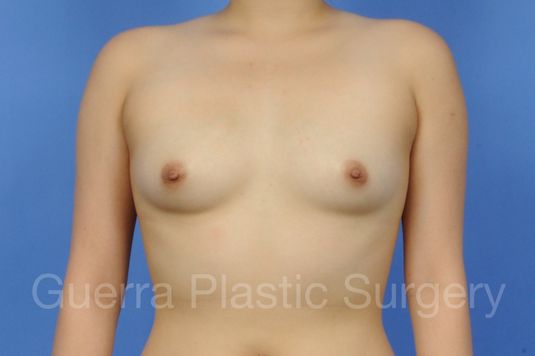 next Case #1001118 Before